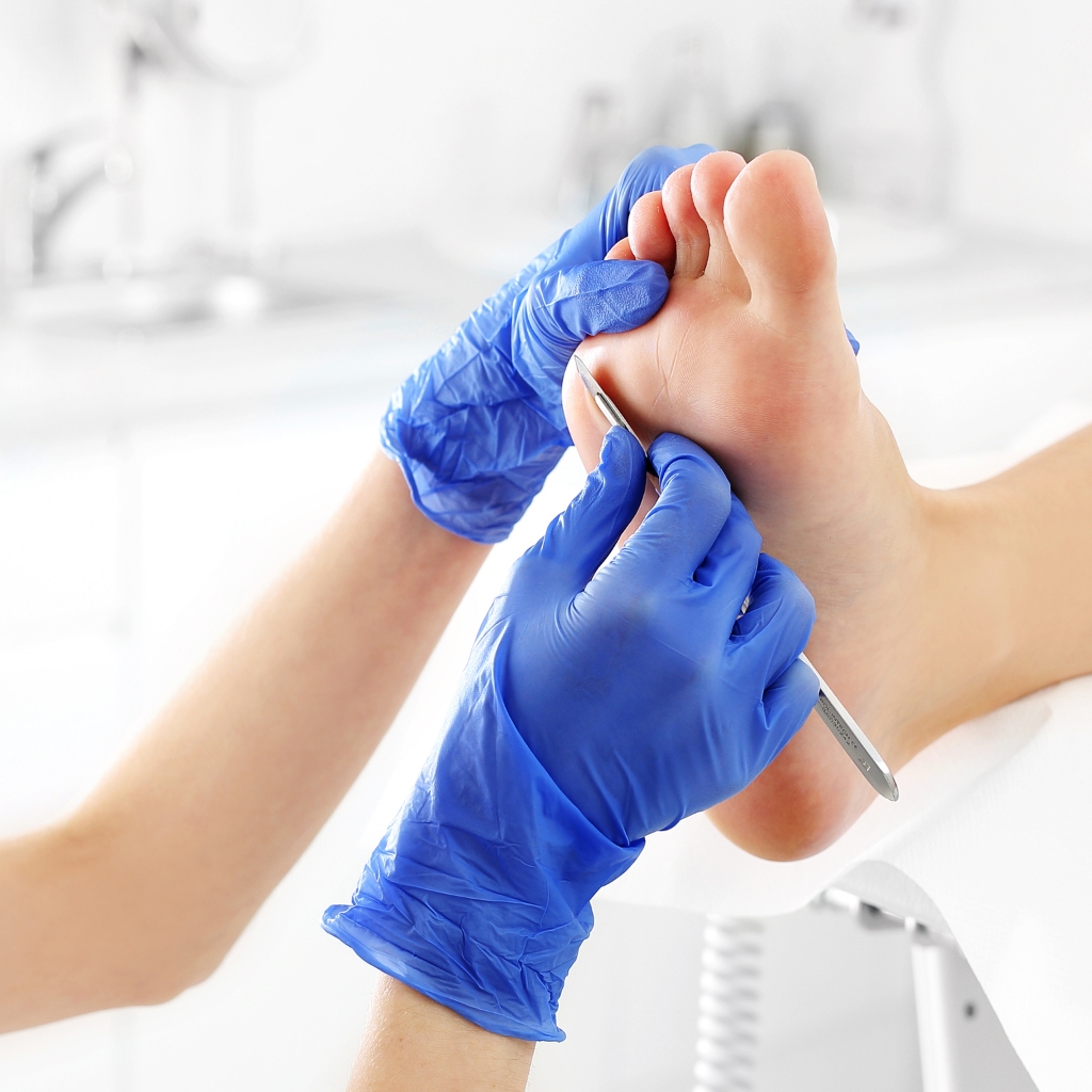 blue gloved hands removed skin from the skin of a white person's foot with a metal scalpel